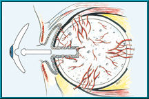 Figure 1. Bio-eye orbital implant after tissue ingrowth (optional peg system shown).