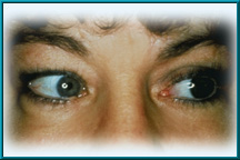 Figure 4. Natural movement with the Bio-eye orbital implant