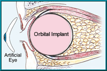 Figure 1. Orbital implant with artificial eye (shown removed)