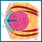 Figure 1. Vascularized Bio-eye with peg